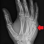 Restoring Function and Confidence after Hand and Wrist fractures Hand Fracture