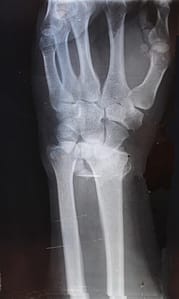 Fractures of the Hand & Wrist Wrist Fracture