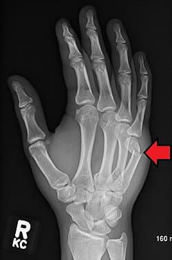 Restoring Function and Confidence after Hand and Wrist fractures Hand Fracture
